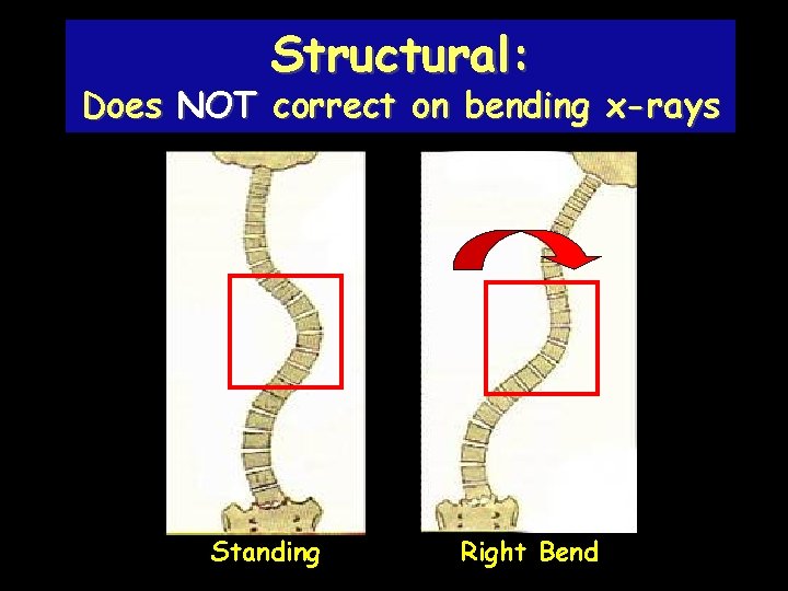 Structural: Does NOT correct on bending x-rays Standing Right Bend 