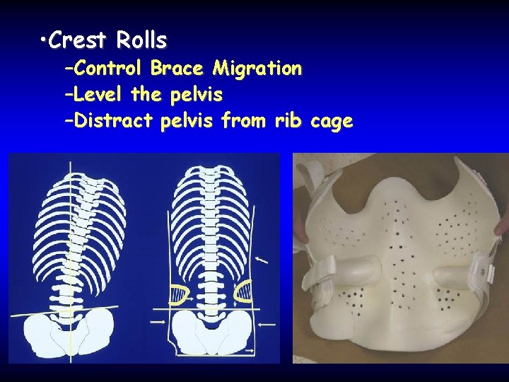  • Crest Rolls –Control Brace Migration –Level the pelvis –Distract pelvis from rib