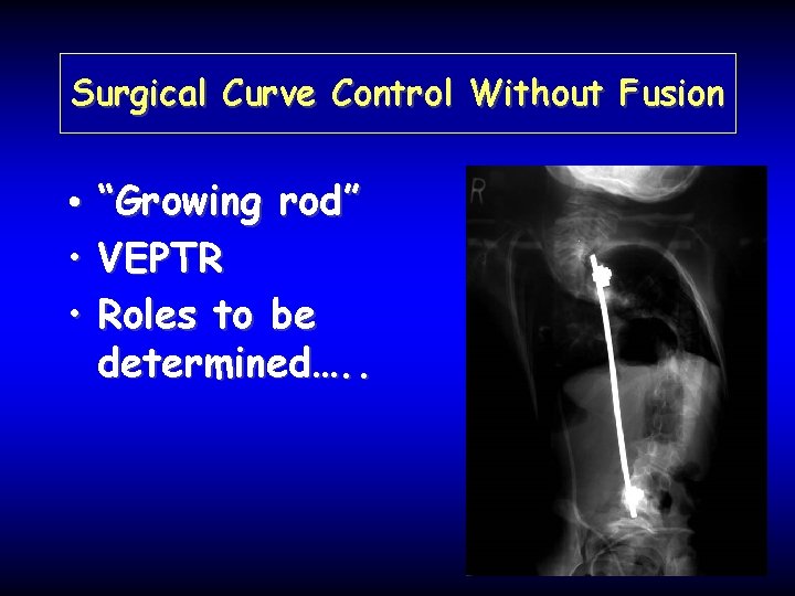 Surgical Curve Control Without Fusion • “Growing rod” • VEPTR • Roles to be