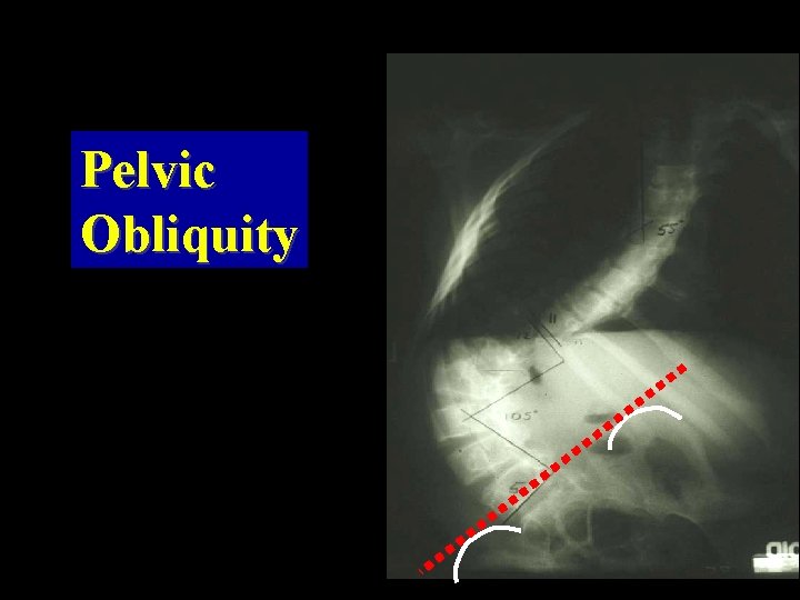 Pelvic Obliquity 