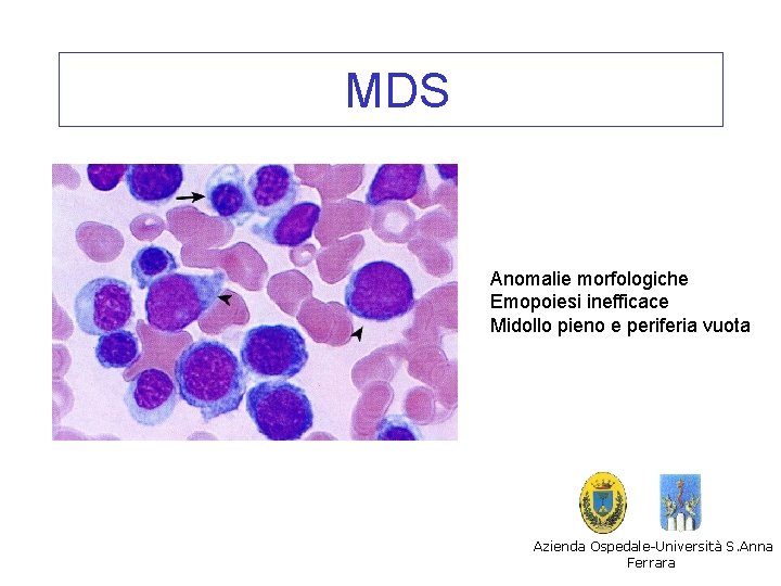 MDS Anomalie morfologiche Emopoiesi inefficace Midollo pieno e periferia vuota Azienda Ospedale-Università S. Anna MDS Anomalie morfologiche Emopoiesi inefficace Midollo pieno e periferia vuota Azienda Ospedale-Università S. Anna