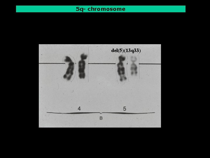 5 q- chromosome del(5)(13 q 33) 5 q- chromosome del(5)(13 q 33)