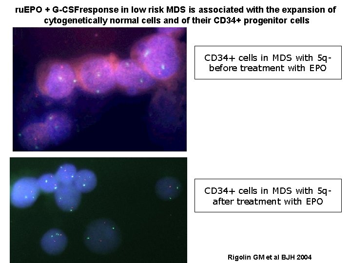 ru. EPO + G-CSFresponse in low risk MDS is associated with the expansion of ru. EPO + G-CSFresponse in low risk MDS is associated with the expansion of