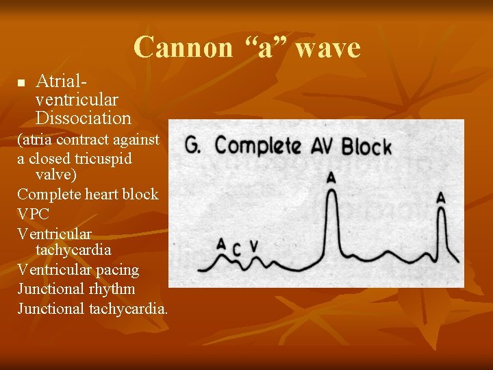 Cannon “a” wave n Atrialventricular Dissociation (atria contract against a closed tricuspid valve) Complete