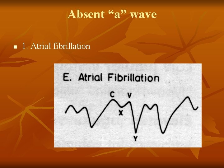 Absent “a” wave n 1. Atrial fibrillation 