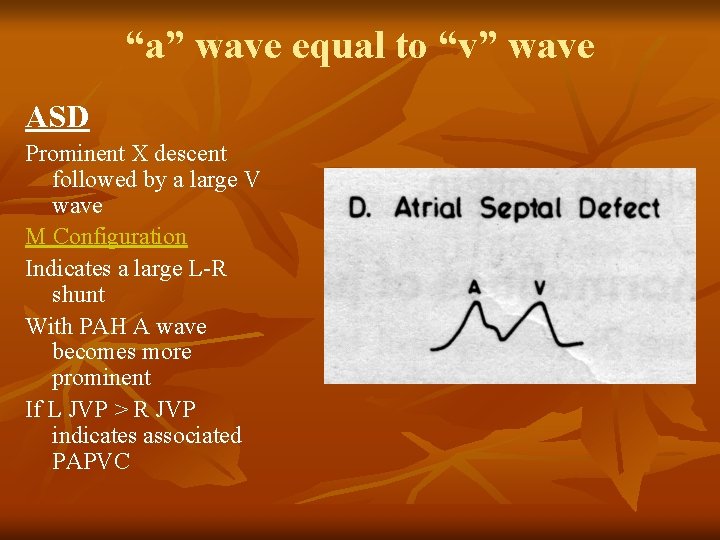 “a” wave equal to “v” wave ASD Prominent X descent followed by a large