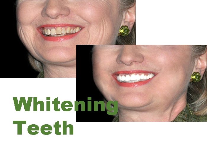 Whitening Teeth 