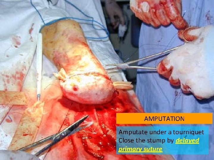 AMPUTATION Amputate under a tourniquet Close the stump by delayed primary suture 