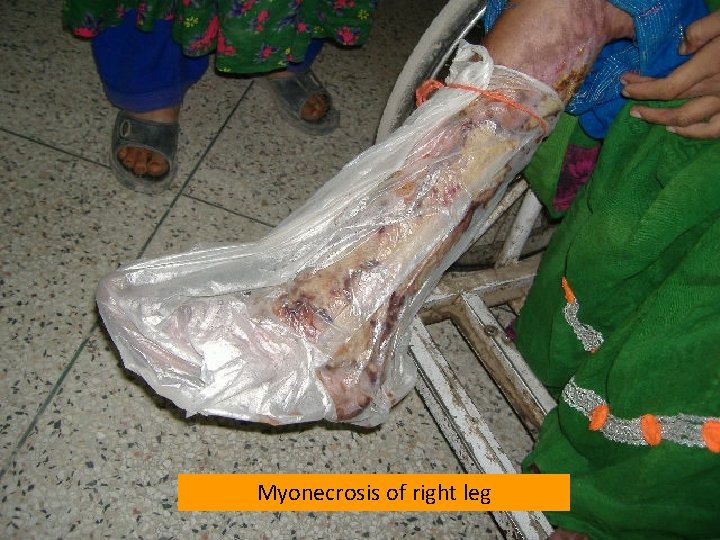 Myonecrosis of right leg 