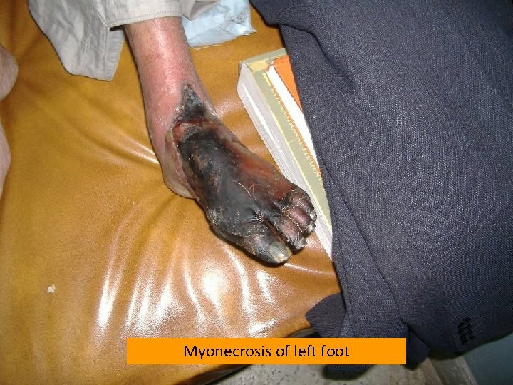 Myonecrosis of left foot 