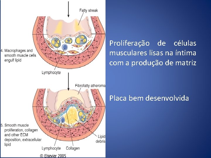 Proliferação de células musculares lisas na íntima com a produção de matriz Placa bem