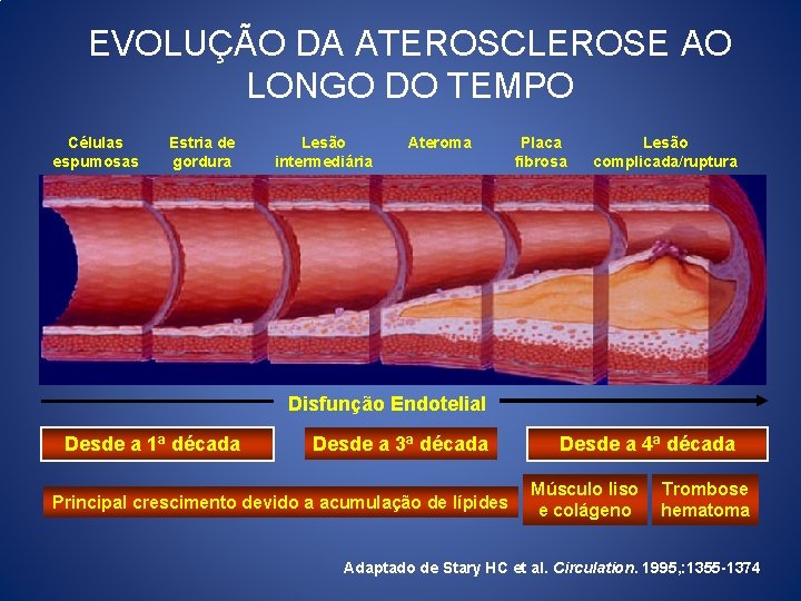 EVOLUÇÃO DA ATEROSCLEROSE AO LONGO DO TEMPO Células espumosas Estria de gordura Lesão intermediária