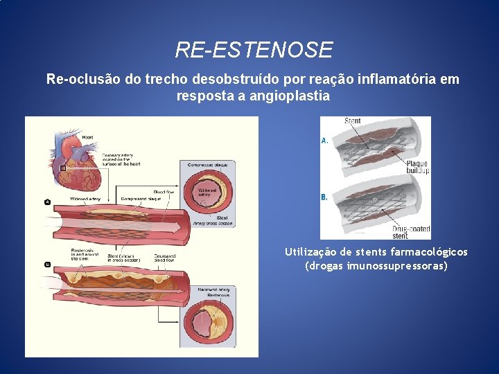 RE-ESTENOSE Re-oclusão do trecho desobstruído por reação inflamatória em resposta a angioplastia Utilização de