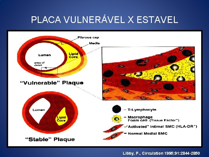 PLACA VULNERÁVEL X ESTAVEL Libby, P. , Circulation 1995; 91: 2844 -2850 