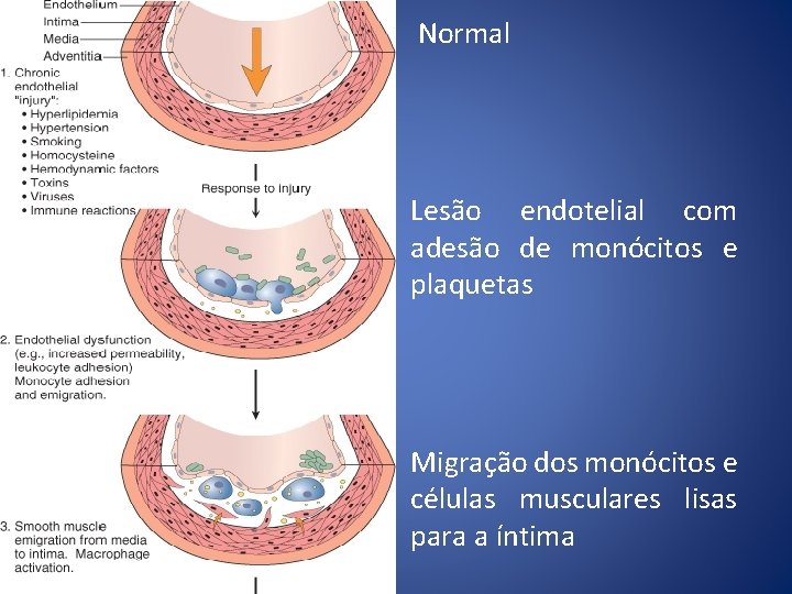 Normal Lesão endotelial com adesão de monócitos e plaquetas Migração dos monócitos e células
