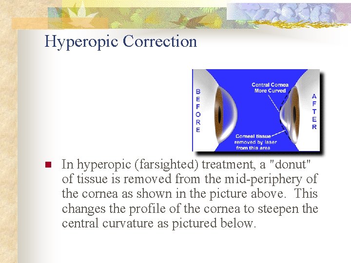 Hyperopic Correction n In hyperopic (farsighted) treatment, a "donut" of tissue is removed from