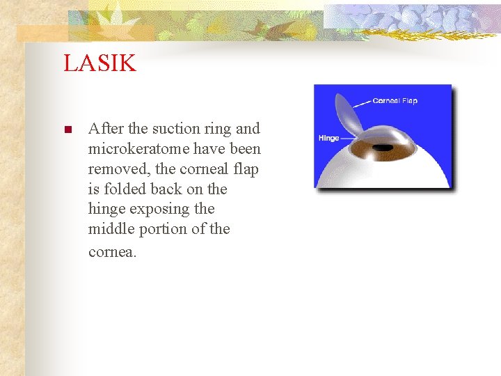 LASIK n After the suction ring and microkeratome have been removed, the corneal flap