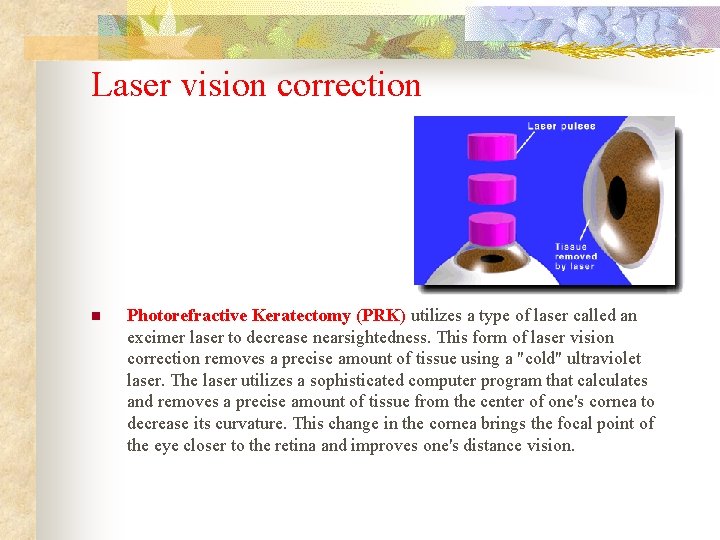 Laser vision correction n Photorefractive Keratectomy (PRK) utilizes a type of laser called an