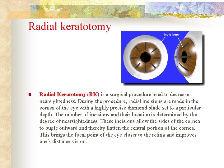 Radial keratotomy n Radial Keratotomy (RK) is a surgical procedure used to decrease nearsightedness.