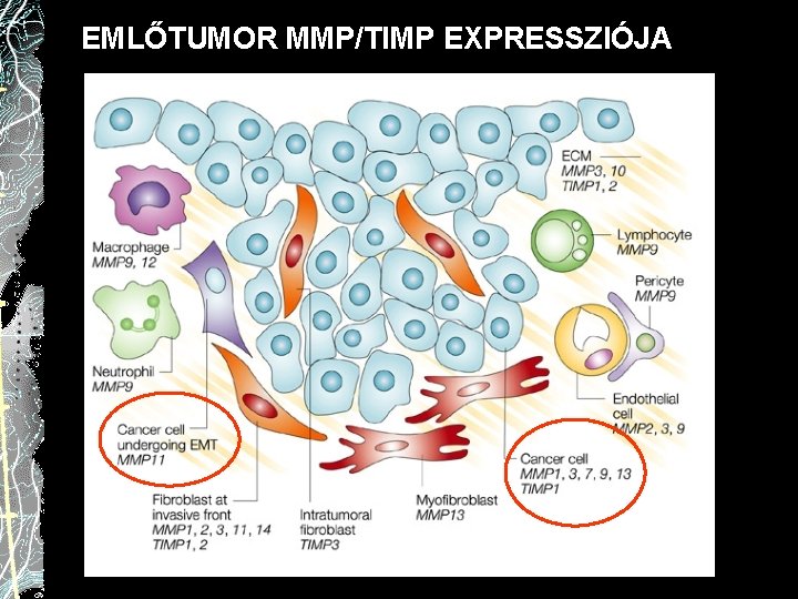 EMLŐTUMOR MMP/TIMP EXPRESSZIÓJA 