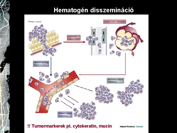 Hematogén disszemináció !! Tumormarkerek pl. cytokeratin, mucin 