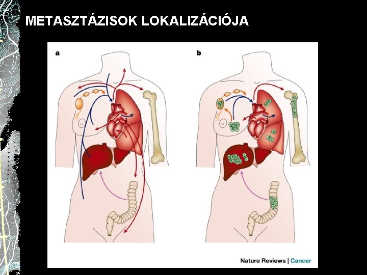 METASZTÁZISOK LOKALIZÁCIÓJA 