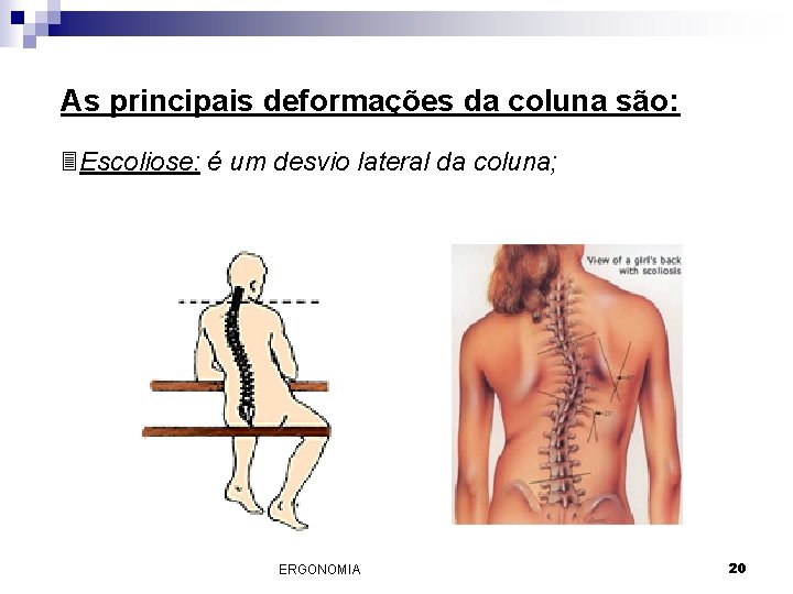 As principais deformações da coluna são: 3 Escoliose: é um desvio lateral da coluna;