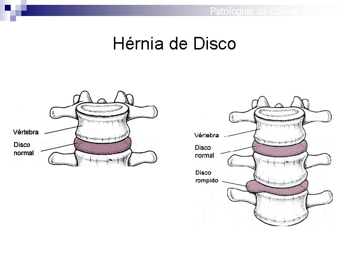 Patologias da Coluna Vertebral Hérnia de Disco 