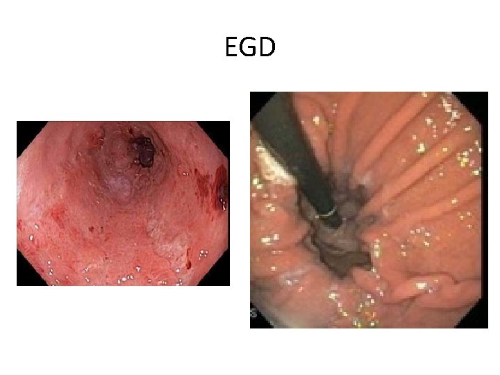 EGD 