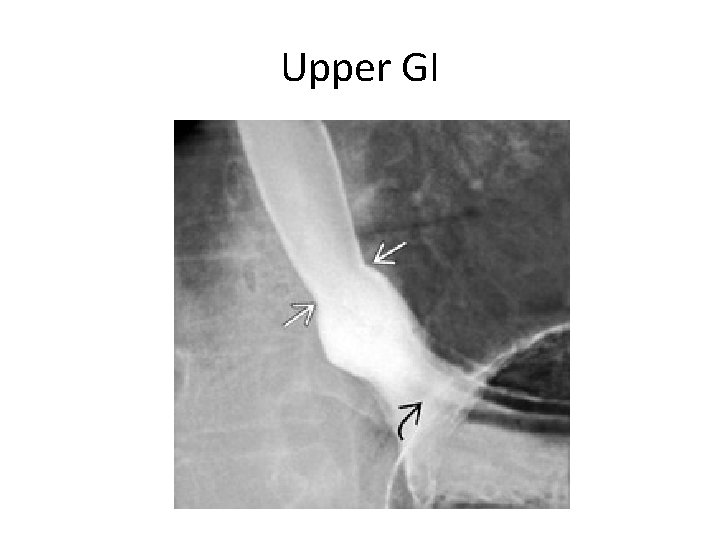 Upper GI 