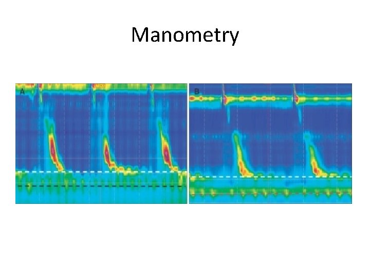 Manometry 