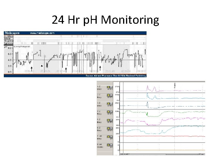 24 Hr p. H Monitoring 