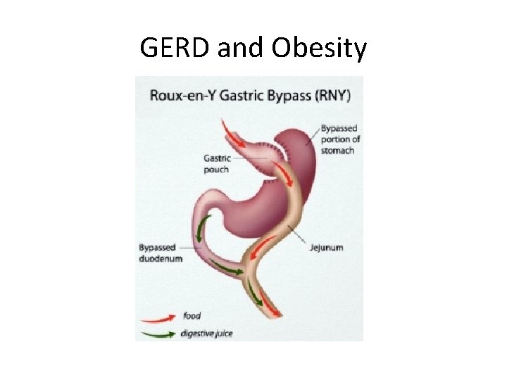 GERD and Obesity 