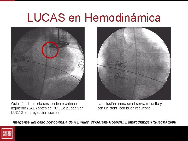 LUCAS en Hemodinámica Oclusión de arteria descendente anterior izquierda (LAD) antes de PCI. Se LUCAS en Hemodinámica Oclusión de arteria descendente anterior izquierda (LAD) antes de PCI. Se