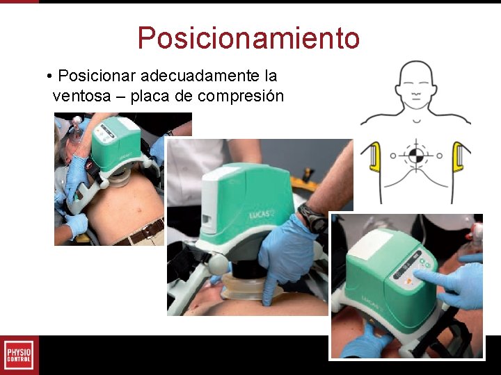Posicionamiento • Posicionar adecuadamente la ventosa – placa de compresión Posicionamiento • Posicionar adecuadamente la ventosa – placa de compresión