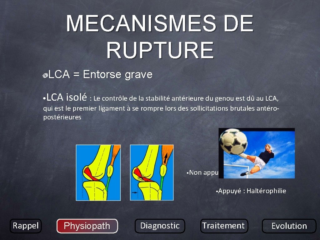 MECANISMES DE RUPTURE LCA = Entorse grave • LCA isolé : Le contrôle de