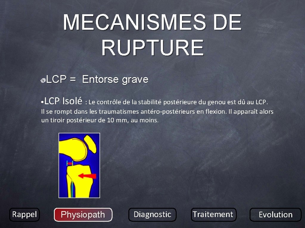 MECANISMES DE RUPTURE LCP = Entorse grave • LCP Isolé : Le contrôle de