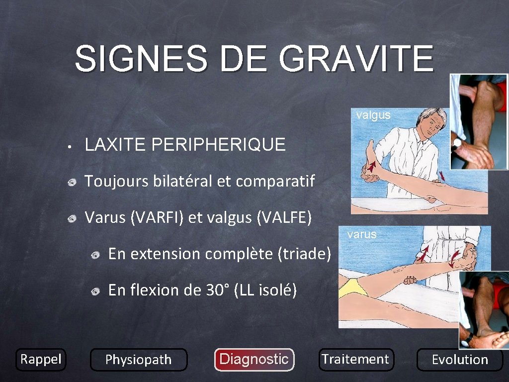 SIGNES DE GRAVITE valgus • LAXITE PERIPHERIQUE Toujours bilatéral et comparatif Varus (VARFI) et