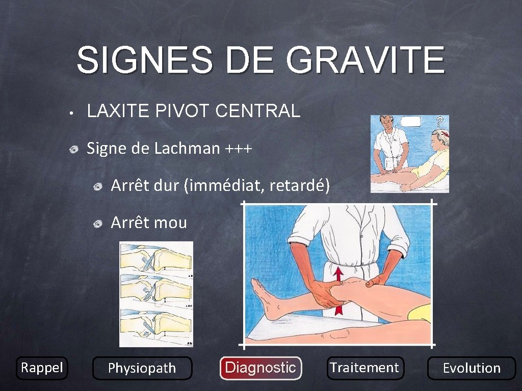 SIGNES DE GRAVITE • LAXITE PIVOT CENTRAL Signe de Lachman +++ Arrêt dur (immédiat,
