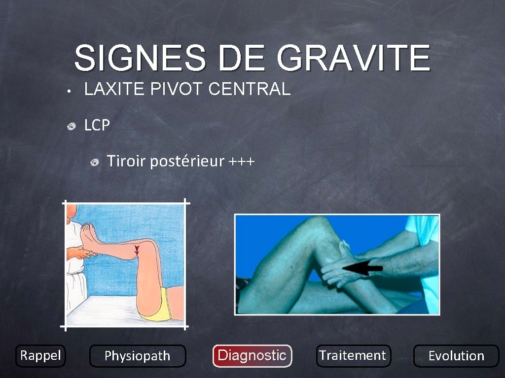SIGNES DE GRAVITE • LAXITE PIVOT CENTRAL LCP Tiroir postérieur +++ Rappel Physiopath Diagnostic