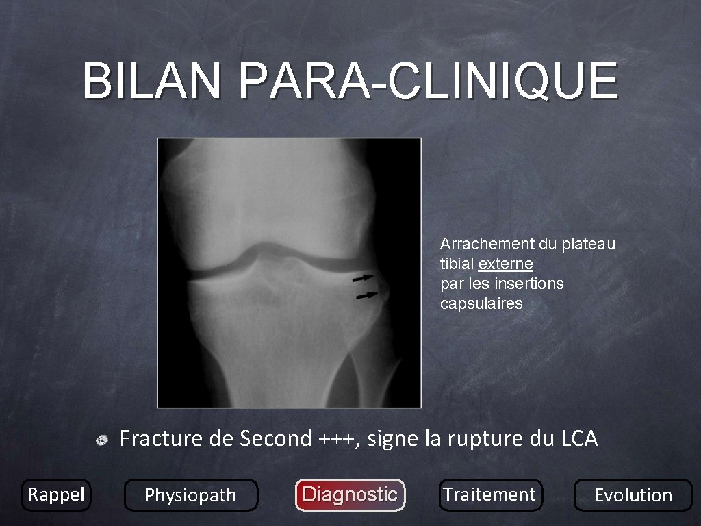 BILAN PARA-CLINIQUE Arrachement du plateau tibial externe par les insertions capsulaires Fracture de Second