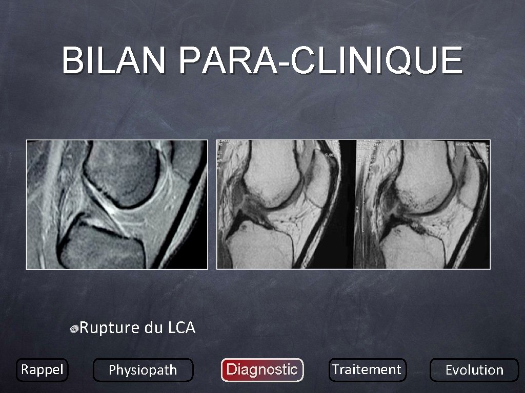 BILAN PARA-CLINIQUE Rupture du LCA Rappel Physiopath Diagnostic Traitement Evolution 