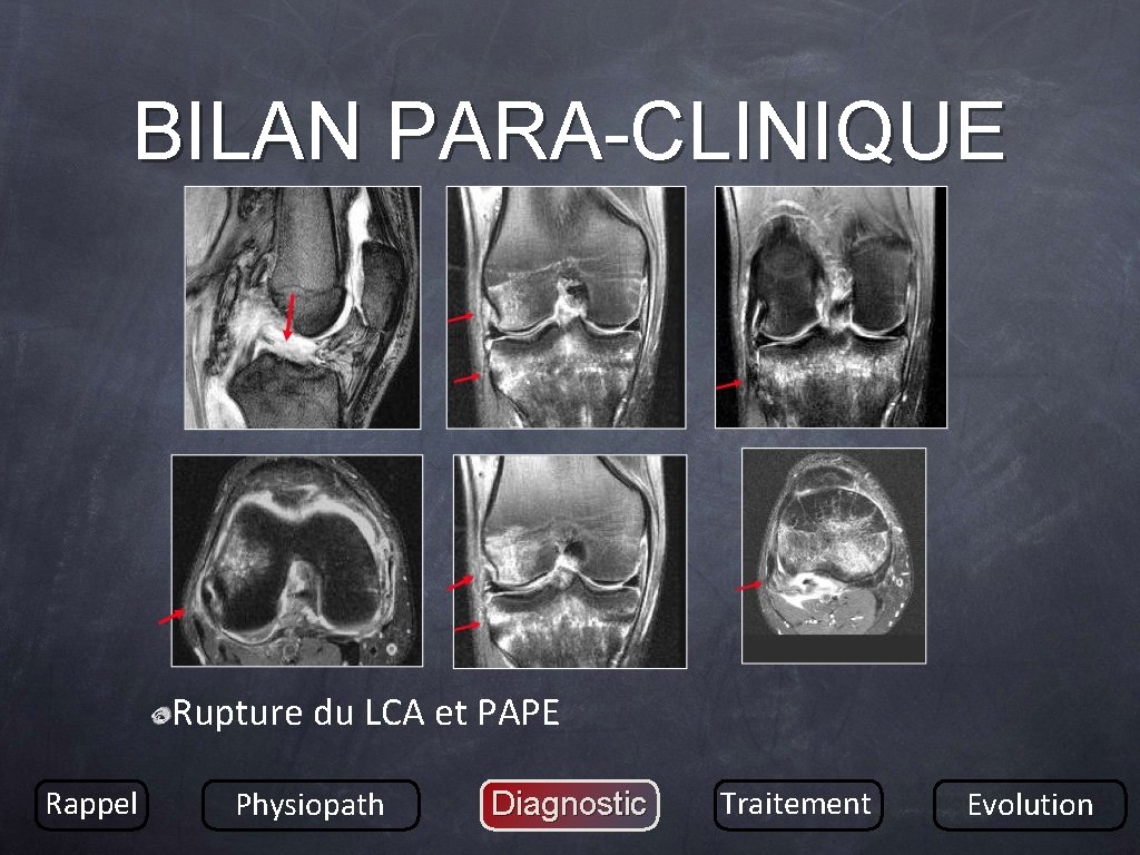 BILAN PARA-CLINIQUE Rupture du LCA et PAPE Rappel Physiopath Diagnostic Traitement Evolution 