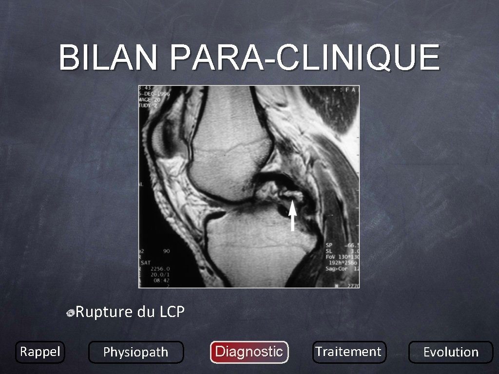 BILAN PARA-CLINIQUE Rupture du LCP Rappel Physiopath Diagnostic Traitement Evolution 