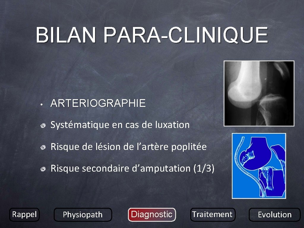 BILAN PARA-CLINIQUE • ARTERIOGRAPHIE Systématique en cas de luxation Risque de lésion de l’artère