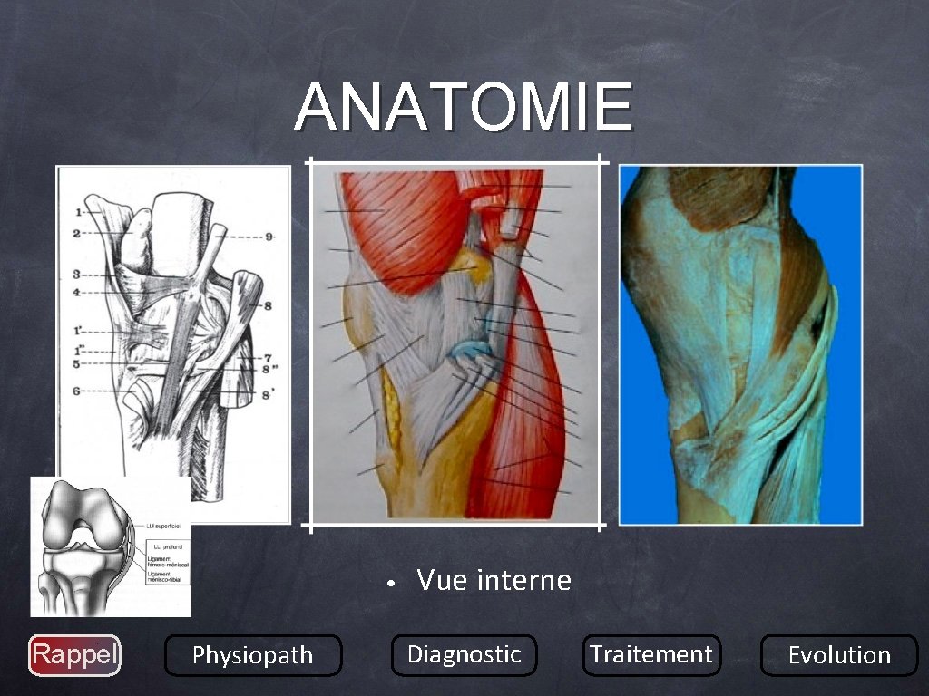 ANATOMIE • Rappel Physiopath Vue interne Diagnostic Traitement Evolution 