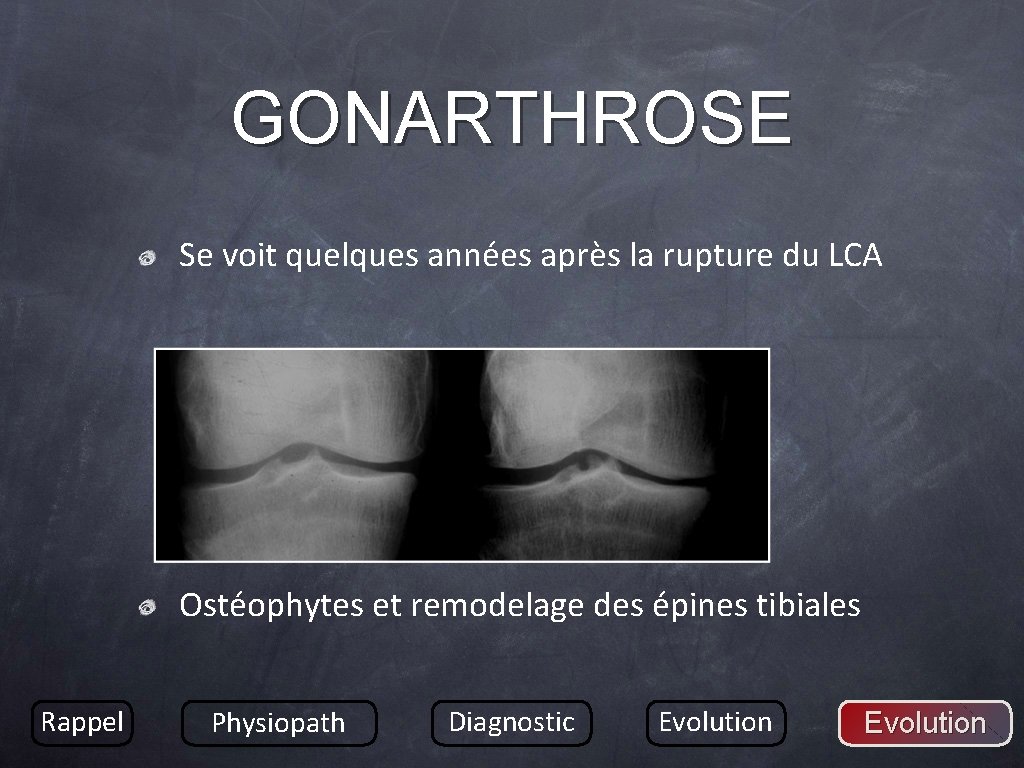GONARTHROSE Se voit quelques années après la rupture du LCA Ostéophytes et remodelage des