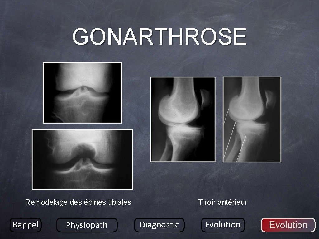 GONARTHROSE Remodelage des épines tibiales Rappel Physiopath Tiroir antérieur Diagnostic Evolution 