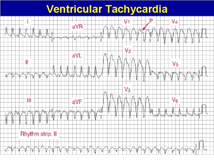 Ventricular Tachycardia 