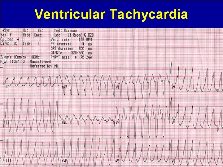 Ventricular Tachycardia 